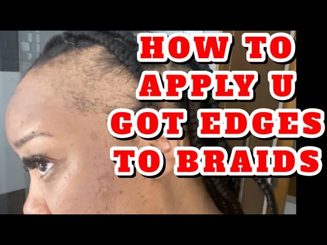 HOW TO COVER BALD SPOTS or NO EDGES • U GOT EDGES x BRAIDS | Severe Alopecia | Instant Edges