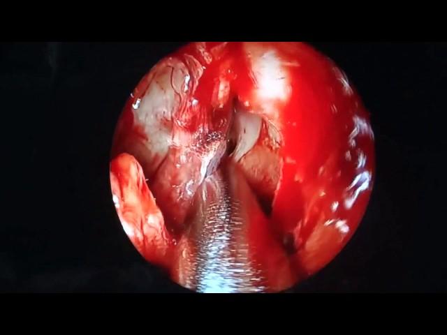 superir turbinate removal by microdbrider