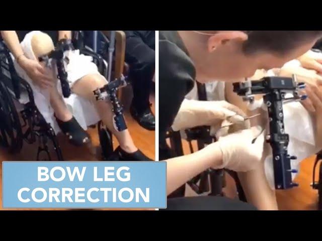 Bow Leg Correction Post-Op clip