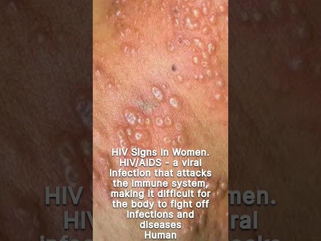 HIV/AIDS SIGNS AND SYMPTOMS IN WOMAN  https://youtu.be/ICPJcosSGTU