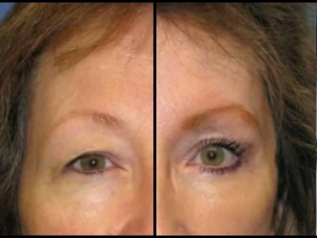 Face Lift - Dr. John Bitner