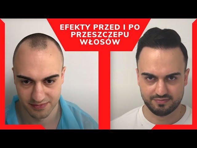 Przeszczep włosów - efekty przed i po. Tak będziesz wyglądać 3 lata po zabiegu. Metoda FUE.