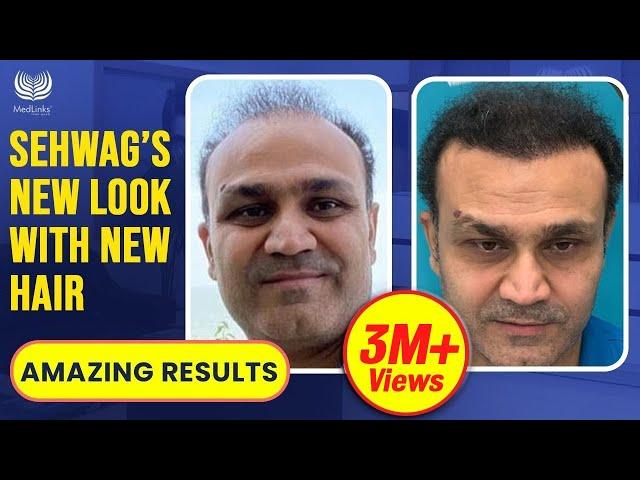 Virender Sehwag's Hair Transplant Results 2024 | Cricketer/Celebrity Hair Transplant In India