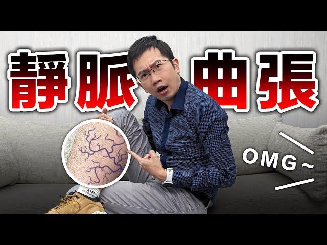 靜脈曲張嚴重恐致命! 每天抬腿竟然沒用!? feat. 靜脈大王 張學倫醫師