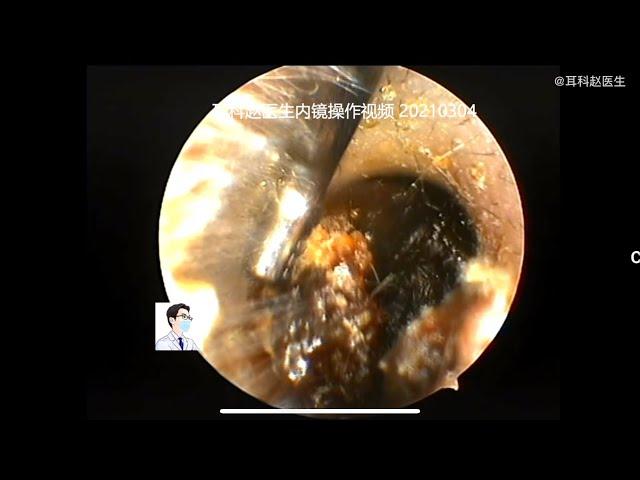 Satisfying Removal Video With Dr Zhao Binaural in a child, 10 min