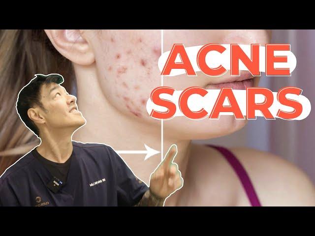 How to Treat Pigmented Acne Scars | Dr Davin Lim