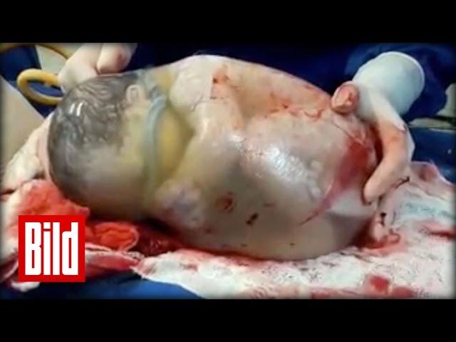 Baby in Fruchtblase geboren - Hammer Video