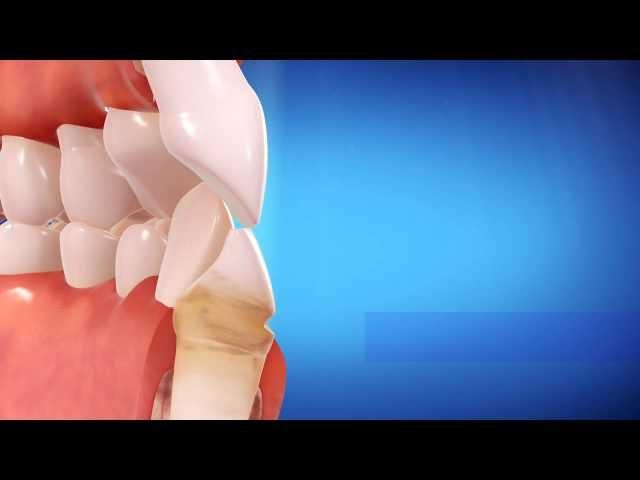 Straight Talk About Invisalign
