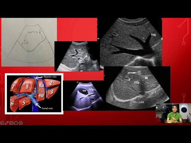 ULTRASOUND-LIVER SEGMENTS COUINAUD'S CLASSIFICATION