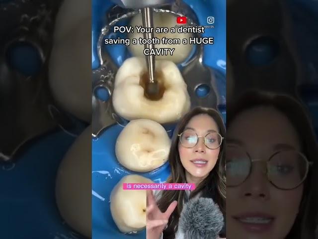 Saving a tooth from a huge cavity! #cavity #filling #dentistry