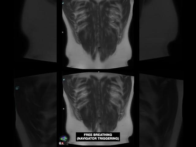 OPTIMISING HASTE SEQUENCE # MRI