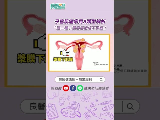 子宮肌瘤常見3類型解析「這一種」最容易造成不孕症 ft.陳保仁醫師 #shorts #shortvideo #子宮肌瘤 #不孕症