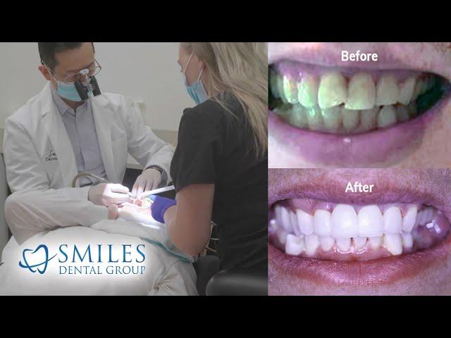 Cosmetic Smile Enhancement Procedures (Pre Covid)