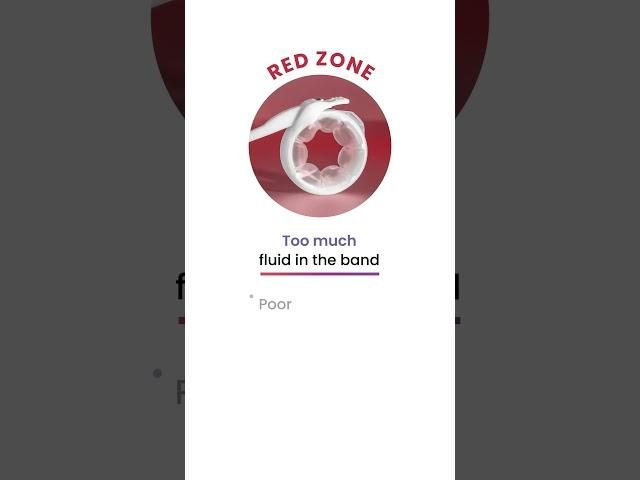 ReShape Lap-Band® Procedure | Adjust the Lap-Band® To Optimize Weight Loss