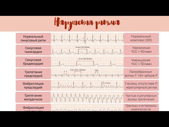 Норма и патология на ЭКГ: Нарушения Ритма