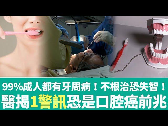 【健康療天室】99%成人都有牙周病！不根治恐增失智風險　醫揭1警訊恐是口腔癌前兆｜中時新聞網