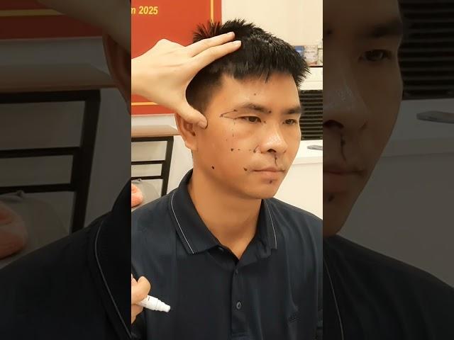 HỌC XOA BÓP BẤM HUYỆT P6: CÁC HUYỆT CHỮA LIỆT NỬA MẶT
