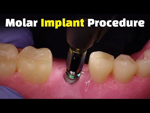 Step by Step Dental Implant Procedure - Back Molar