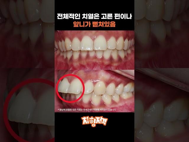 돌출입 교정 과정 #돌출입교정 #돌출입교정전후