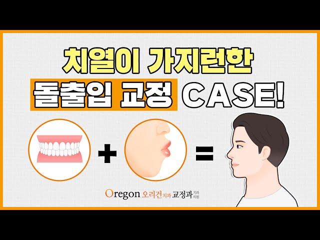 치열이  가지런한 돌출입 교정 케이스 소개 [ 강남교정치과 - 오리건치과 ]