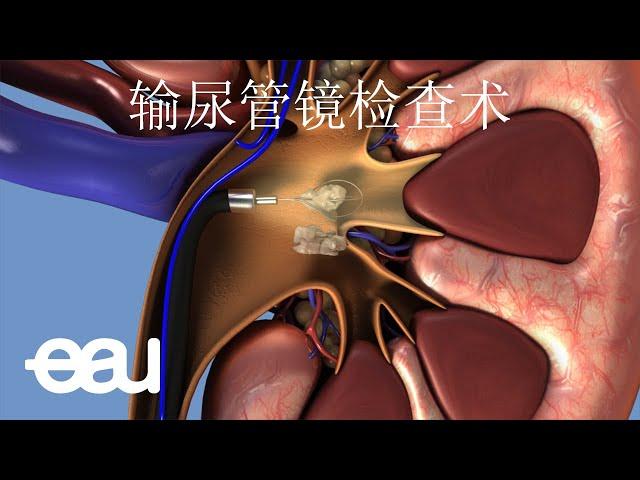 输尿管镜手术 (Ureteroscopy - URS)