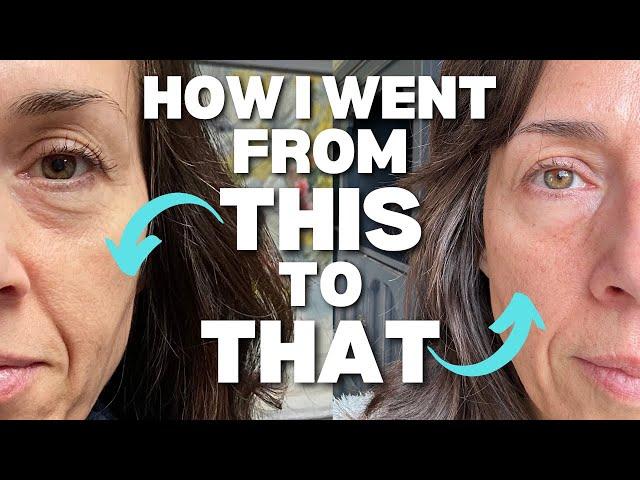 ANTI-AGING LASER TREATMENT AT 52 | Does It Work?