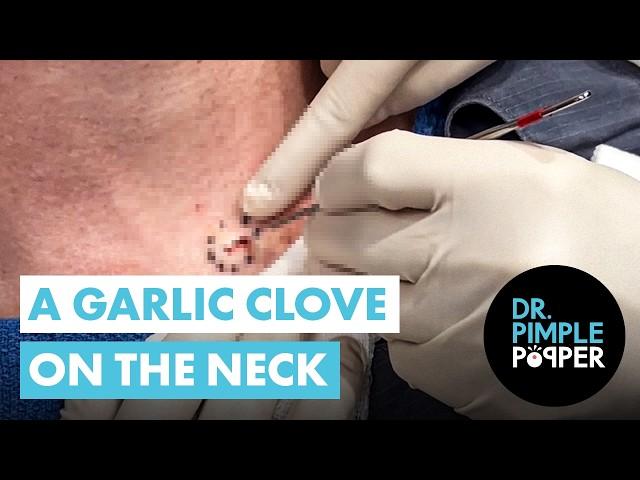 A Garlic Clove on the Neck