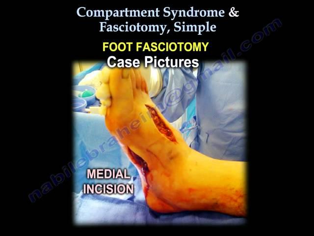 Compartment Syndrome & Fasciotomy, Simple - Everything You Need To Know - Dr. Nabil Ebraheim