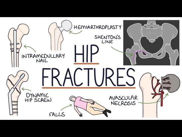 Understanding Hip Fractures and Hip Surgery