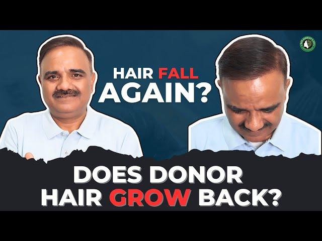 Do Hair Transplants Ever Look Natural?