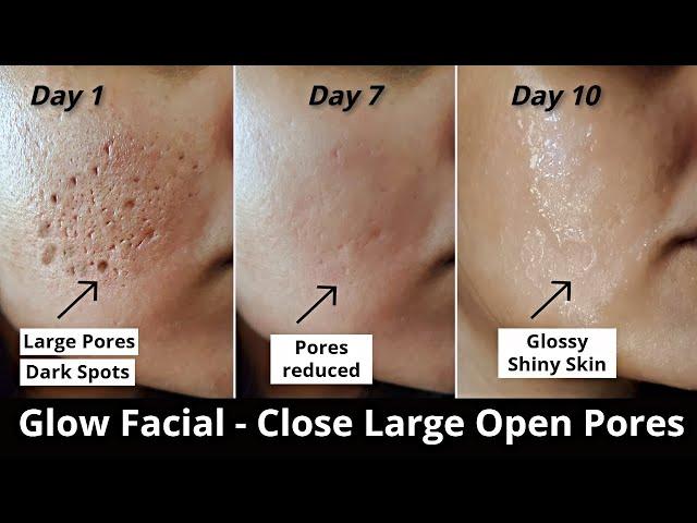 4 Step Glow Facial - Close Large OPEN PORES, Remove DARK SPOTS & get Glowing Skin - Aloevera icecube