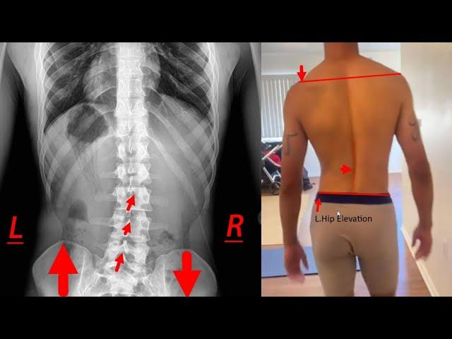 Left AIC or Opposite  ? Left Pelvic Tilt – groin, back, and neck pain RESOLVED