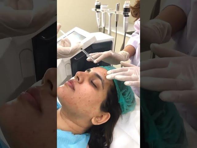 Elevate Your Beauty Routine with RF Microneedling | Aesthetics Lab