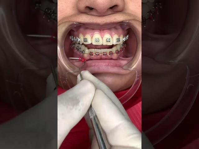  #teeth
