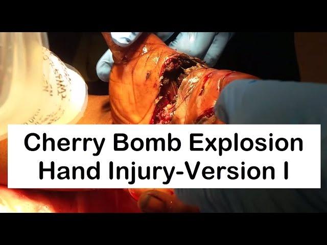 Cherry Bomb Explosion Hand Injury-Version I