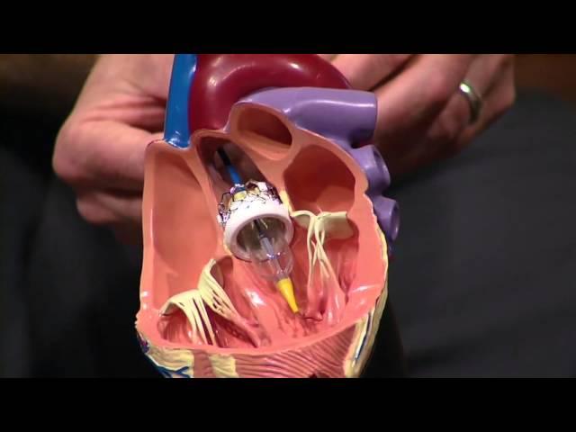 Heart Catheterization