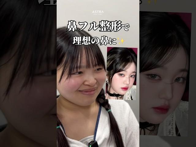 【理想の鼻に近づきたい！ #忘れ鼻#鼻整形#塩満先生#アストラビューティークリニック#astrabeautyclinic#渋谷#美容整形#ウォニョン 】