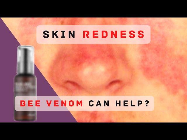 Tired of Red irritated skin?! | Benton snail bee high content essence review | 2022