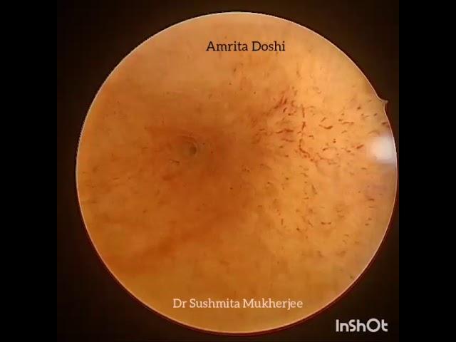 Hysteroscopic septum resection | Dr. Sushmita Mukherjee
