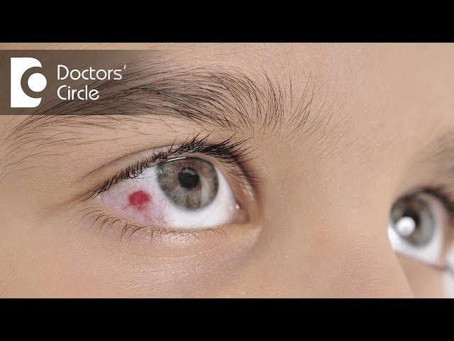 What is a fungal eye infection? - Dr. Sunita Rana Agarwal