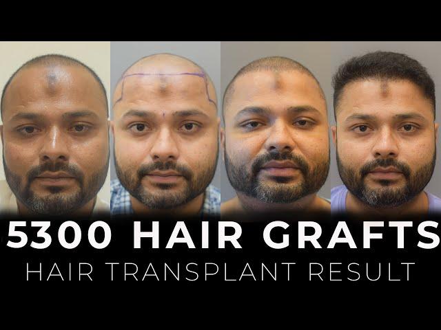 You Won't Believe the Hair Transplant Results Got at Cara Clinic!