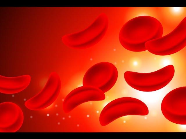 Sickle Cell Anemia