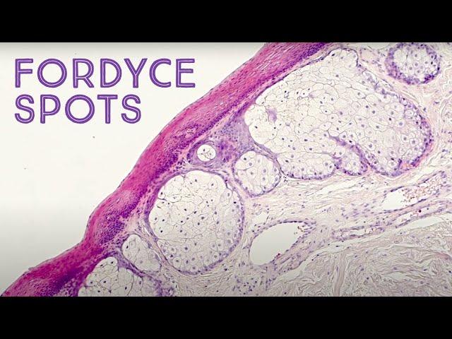 Fordyce Spots ("oil glands") under the microscope (Montgomery tubercles, Tyson glands, sebaceous)