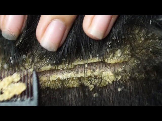 Dandruff scratching removal on head using black combing#53