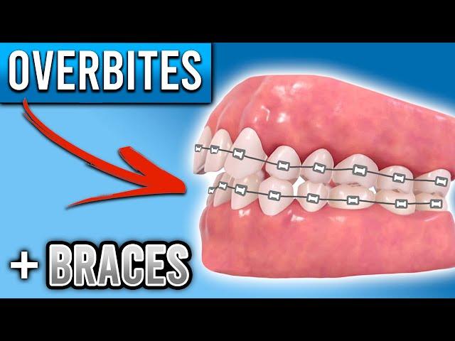 How Do BRACES FIX Overbites? | Overbite Before and After Braces | Premier Orthodontics