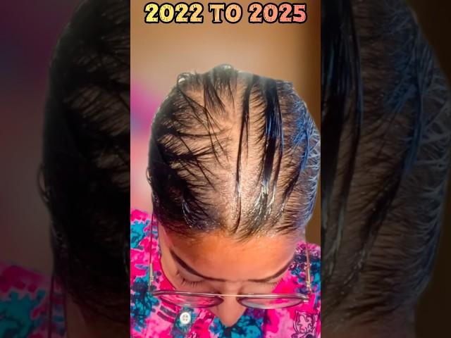 My Bald Hair Growth Journey2022 To 2025#selflovedayesha#shortsfeed#shorts#viralshorts#hairgrowth