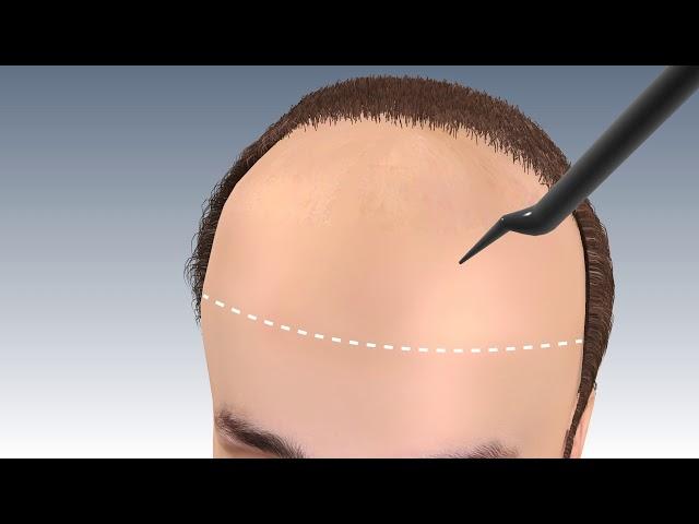 Step by Step FUE Hair Transplant Surgery in jaipur | Hair transplant in india | Outbloom clinics