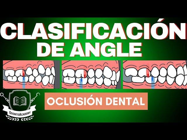 CLASIFICACIÓN DE LAS MALOCLUSIONES | CLASIFICACIÓN DE ANGLE | oclusión dental.