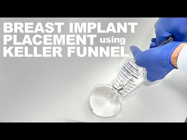 Breast Implant Placement using the Keller Funnel - Dr. Paul Ruff | West End Plastic Surgery