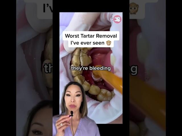 Heavy Tartar Removal #shorts